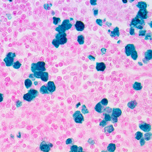 3. IHC of ALK on a FFPE Anaplastic Large Cell Lymphoma Tissue Webpage