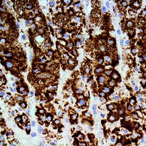 3. IHC of Adipohilin on a FFPE Squamous Cell Carcinoma Tissue Webpage