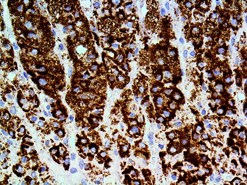 3. Ihc Of Adipohilin On A Ffpe Squamous Cell Carcinoma Tissue Webpage