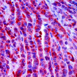 3. IHC of BRAF V600E on a FFPE Papillary Thyroid Carcinoma Tissue Webpage