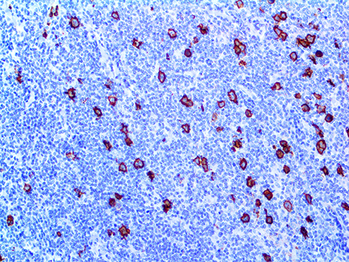 3. IHC of CD15 on a FFPE Hodgkins Lymphoma Tissue Webpage