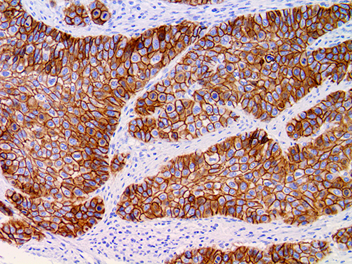 3. Ihc Of Desmoglein 3 On A Ffpe Squamous Cell Carcinoma Tissue Webpage