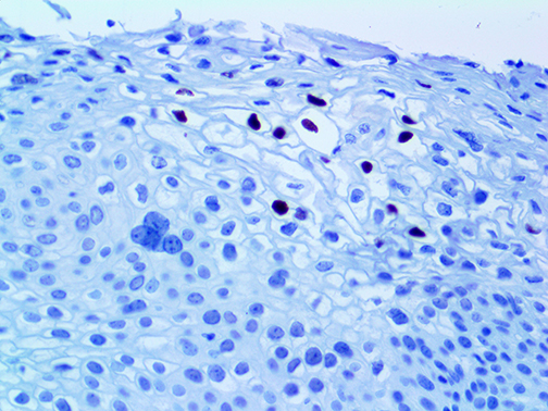 3. Ihc Of Hpv16 On A Ffpe Infected Cervix Tissue Webpage