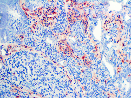 3. Ihc Of Pten On A Ffpe Pancreatic Cancer Tissue Webpage
