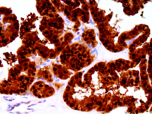3. Ihc Of S100A6 On A Ffpe Ovarian Carcinoma Tissue Webpage