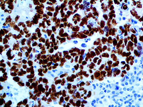 3. IHC of SALL4 MMab of FFPE Testicular Cancer Metastasis to Liver Tissue Webpage
