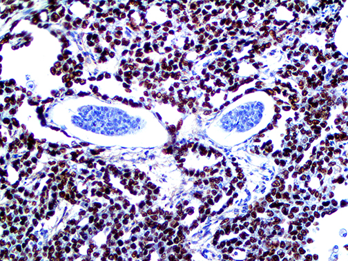 3. IHC of SALL4 RMab of FFPE Testicular Cancer Metastasis to Liver Tissue Webpage