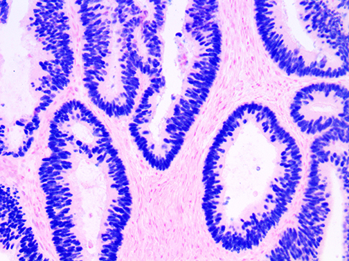 3. Ihc Of Satb2 On A Ffpe Colon Carcinoma Tissue Webpage