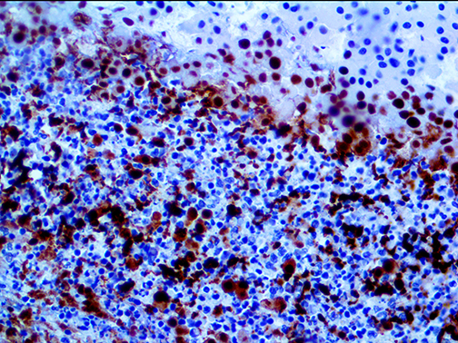 3. Ihc Of Smad4 Dpc4 On A Ffpe Pancreatic Cancer Webpage
