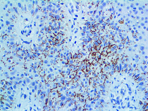 3. IHC of Treponema Pallidum on a FFPE Infected Skin Tissue Webpage