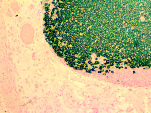IHC of CD20 on an FFPE Colon Tissue