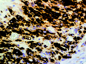 IHC of CD56 on an FFPE Neuroblastoma Tissue