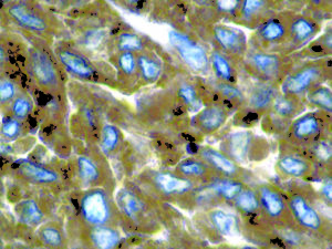 IHC of CD63 on an FFPE Melanoma Tissue