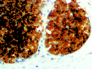 IHC of CD99 on an FFPE Ewing’s Sarcoma Tissue