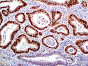 HC of CDK4 on a FFPE Colon Carcinoma Tissue