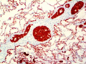 IHC of Cytokeratin 7 & CDX2 on an FFPE Colon Carcinoma Metastasis to Lung Tissue