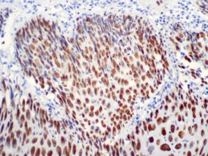 IHC of Cyclin B1 on an FFPE Cervical Cancer Tissue