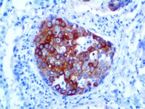 Ihc Of Cytokeratin 20 Rabbit Monoclonal On Ffpe Tissue Colon Cancer Metastasis To Lung Tissue (Dab)