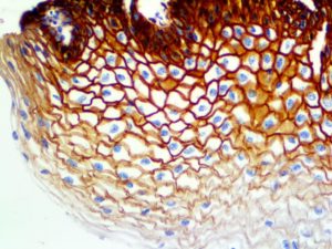 IHC of EGFR Phospho on an FFPE Cervix Tissue