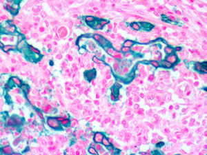 IHC of EpCAM on an FFPE Colon Carcinoma Tissue