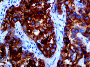 IHC of Glypican-3 on an FFPE Ovarian Carcinoma Tissue