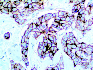 IHC of HER-2 neu on an FFPE Breast Carcinoma Tissue