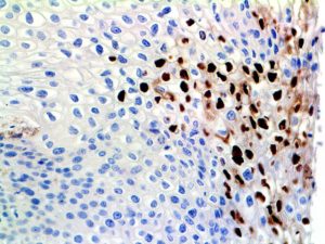HC of HPV on an FFPE LSIL of the Cervix Tissue
