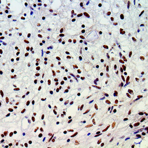 IHC of ATRX on an FFPE Astrocytoma Tissue