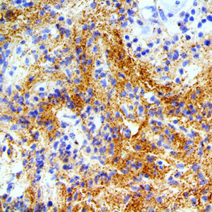 IHC of Alpha Synuclein on an FFPE Astrocytoma Tissue