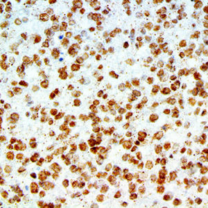 IHC of Amyloid Beta on an FFPE Astrocytoma Tissue