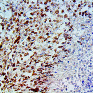 IHC of BAP1 on an FFPE Mesothelioma Tissue