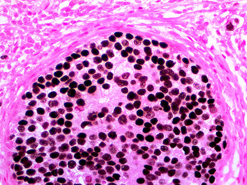 Ihc Of Gata3 On An Ffpe Breast Carcinoma Tissue