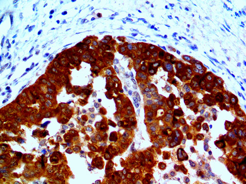Ihc Of He4 On An Ffpe Ovarian Cancer Tissue