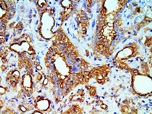 Ihc Of Mesothelial Cell On An Ffpe Mesothelioma Tissue