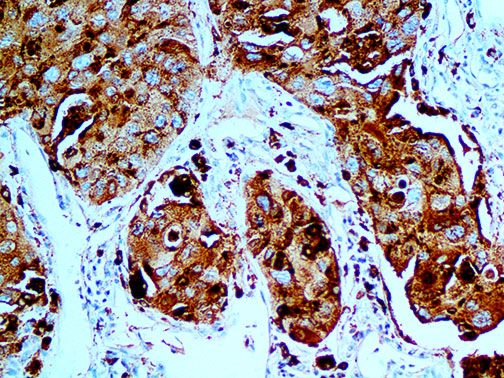 IHC of Napsin A on an FFPE Lung Carcinoma Tissue