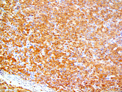 Ihc Of Smad4 On An Ffpe Pancreatic Cancer Tissue