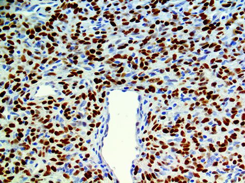 Ihc Of Stat6 On An Ffpe Solitary Fibrous Tumor Tissue