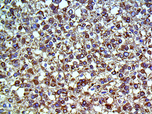 IHC of Tau on an FFPE Astrocytoma Tissue
