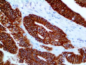 IHC of LI-Cadherin on an FFPE Colon Carcinoma Tissue