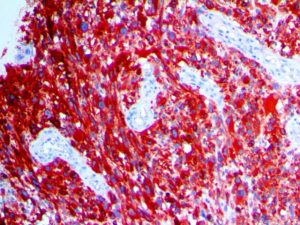 IHC of MART-1/Melan-A on an FFPE Melanoma Tissue