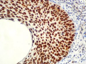 IHC of MCM5 on an FFPE Cervical Cancer Tissue