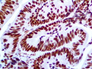 IHC of MLH1 on an FFPE Colon Carcinoma Tissue