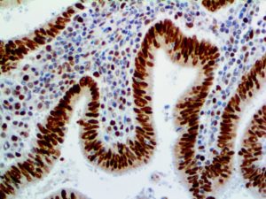 IHC of MSH6 on an FFPE Colon Carcinoma Tissue