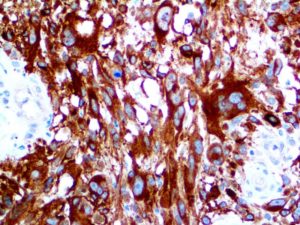 IHC of MART-1/Melan-A on an FFPE Melanoma Tissue