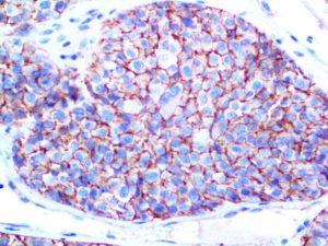 IHC of Melanoma/KBA.62 on an FFPE Melanoma Tissue