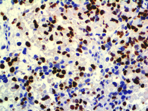 IHC of Myogenin on an FFPE Rhabdomyosarcoma Tissue