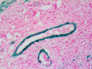 Ihc Of Myosin Smooth Muscle Heavy Chain On An Ffpe Appendix Tissue
