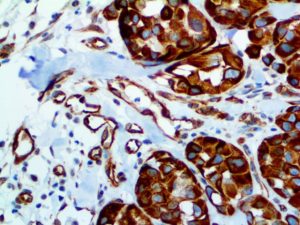 IHC of Nestin on an FFPE Melanoma Tissue