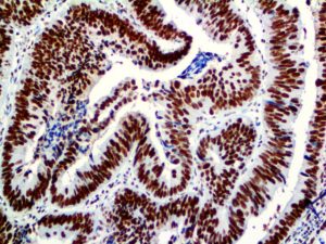 IHC of PMS2 on an FFPE Colon Carcinoma Tissue