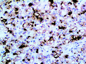 IHC of Renal Cell Carcinoma on an FFPE Kidney Tissue